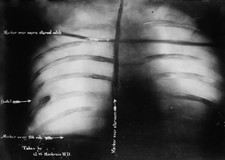 Theodore Roosevelt's chest x-ray after John F Schrank's attempted - Old Photo picture